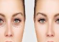 عمل بلفاروپلاستی چیست؟ 