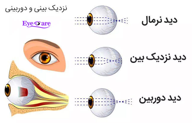 عیوب انکساری 